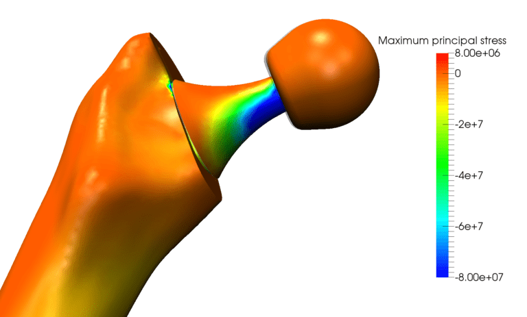 CFD simulation results showing stress and strain in a hip joint prosthesis, biomedical engineering